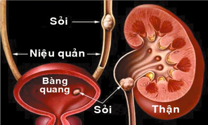 sỏi thận,làm gì khi bị sỏi thận,thận,mổ,uống nhiều nước,lo lắng