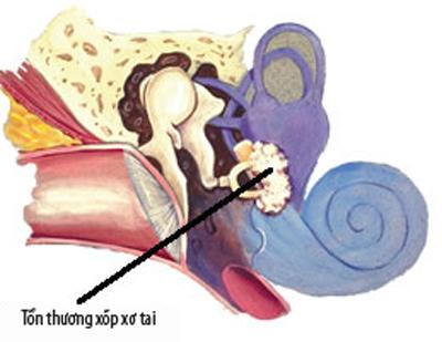 xốp xơ tai,bệnh về tai,di truyền,nhiễm sắc thể,suy giảm truyền dẫn âm thanh