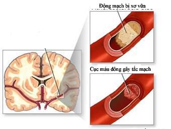 Tai biến mạch não,Bệnh nguy hiểm,Phòng ngừa đột quỵ,Tai biến mùa lạnh