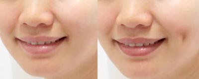 biến chứng,việt nam,hàn quốc,làm đẹp