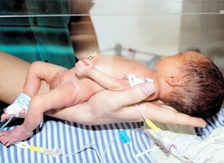 Bệnh viện Phụ sản Hà Nội,Xương thủy tinh,Trẻ sinh ra bị gãy chân tay