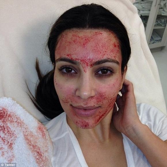 Kim Kardashian 2013,kim siêu vòng ba,Làm đẹp bằng máu người