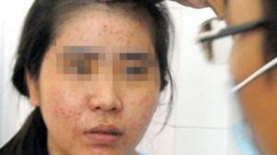 Tẩy trắng da,Kem tẩy trắng,Mặt biến dạng sau tẩy trắng