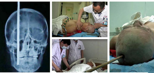 Chuyện lạ 4 phương,Chuyện lạ thế giới,Phi thường,Thép cắm vào đầu