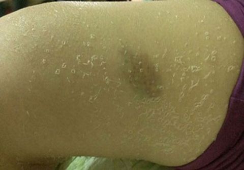 Tắm Trắng,Tẩy trắng da,Kem tẩy trắng,Biến dạng sau tẩy trắng
