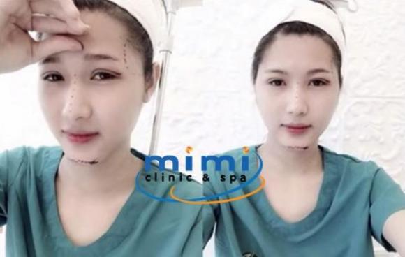 Phẫu thuật thẩm mỹ Angela Baby, Trung tâm thẩm mỹ Mimi clinic-Spa, Trâm Anh, Hiếu Nguyễn