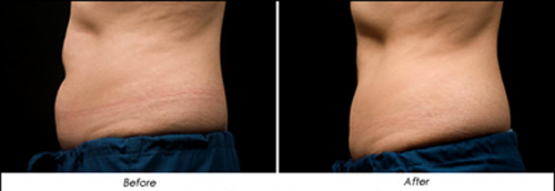 Quang Dũng, Ca sĩ Quang Dũng, Giảm béo, Thẩm mỹ viện giảm béo