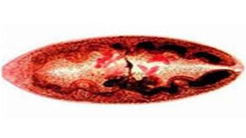 Sán lá phổi, Bệnh sán, Sán ăn phổi bệnh nhân