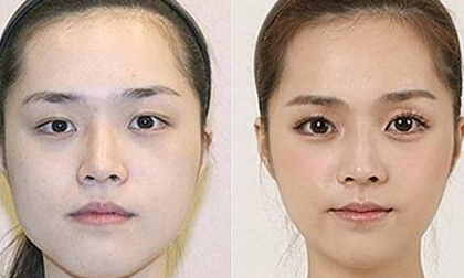 Cắt mí mắt,cận cảnh ca cắt mí mắt của một cô gái