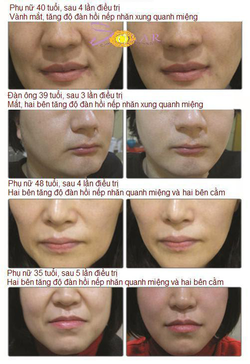 Trẻ hóa da, Căng da mặt, Căng da mặt công nghệ mới, Thẩm mỹ viện căng da mặt, Solar Spa