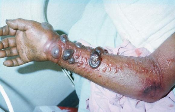 Dịch sốt,dịch sốt xuất huyết Ebola,dịch sốt Ebola tấn công như thế nào