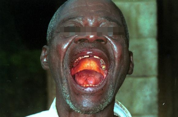 Bệnh dịch,bệnh dịch Ebola,rợn người cảnh chết chóc ở tâm đại dịch Ebola