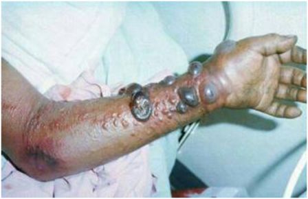 Bệnh Ebola,bệnh dịch Ebola,nguy cơ bệnh dịch tràn vào Việt Nam là rất lớn