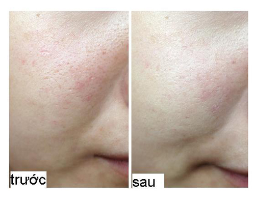 Solar Spa, Thu hẹp lỗ chân lông, Làm trắng da, Thẩm mỹ viện uy tín