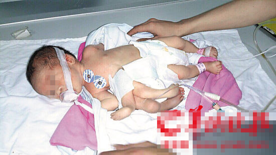 Bé sơ sinh,bé sơ sinh chào đời với 4 tay, 4 chân trên cơ thể
