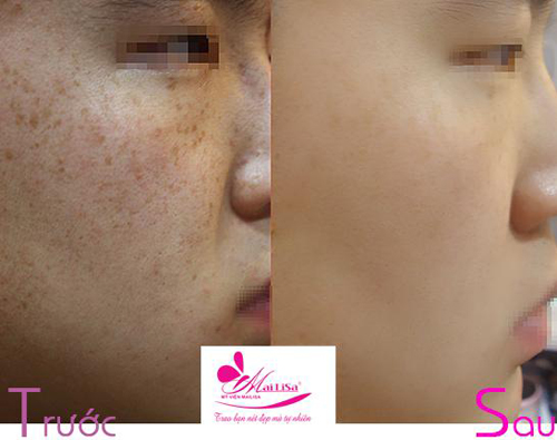Thẩm mỹ viện Mailisa, Trị nám, Trị tàn nhang, Thẩm mỹ viện trị nám, Huy Khánh, Mạc Anh Thư