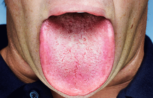 Lưỡi,lưỡi rộng,người đàn ông có lưỡi rộng nhất thế giới