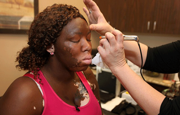 Bệnh lạ,cô gái mắc căn bệnh lạ,cô gái có làn da loang lổ như báo đốm