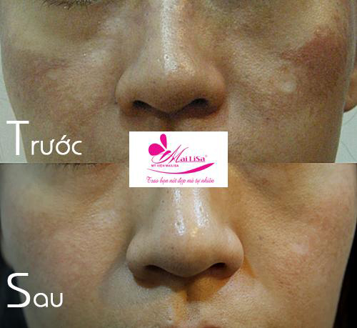 Thẩm mỹ viện Mailisa, Công Vinh, Thủy Tiên, Trị nám, Trị tàn nhang