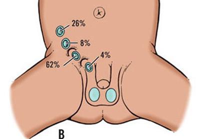 Kỹ năng làm mẹ, Chăm sóc trẻ, Trẻ sơ sinh bị tinh hoàn ẩn
