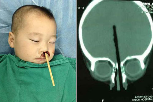 Bé trai,bé trai 2 tuổi bị đũa chọc từ mũi lên não