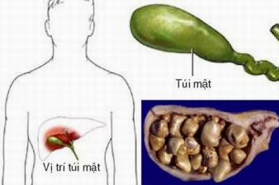 Sỏi mật,Phòng bệnh sỏi mật,Chữa trị sỏi mật