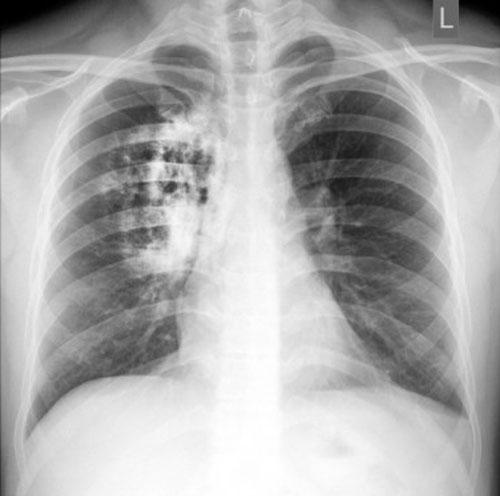 Ung thư phổi,dấu hiệu ung thư phổi,bệnh thường gặp