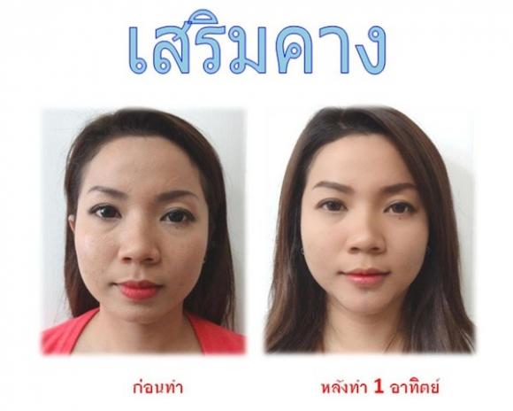 phẫu thuật thẩm mĩ,thái lan,cô gái,phụ nữ,xinh đẹp