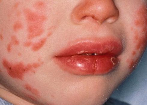 Bệnh lạ,bệnh Kawasaki,căn bệnh lạ đặc biệt nguy hiểm cho trẻ em