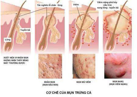 Thẩm mỹ viện Elly Queen, Trị mụn trứng cá, Điều trị mụn trứng cá, Thẩm mỹ viện trị mụn trứng cá