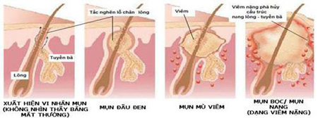 Thẩm mỹ viện Elly Queen, Trị mụn trứng cá, Điều trị mụn trứng cá, Thẩm mỹ viện trị mụn trứng cá