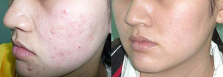Thẩm mỹ viện Elly Queen, Trị mụn trứng cá, Điều trị mụn trứng cá, Thẩm mỹ viện trị mụn trứng cá