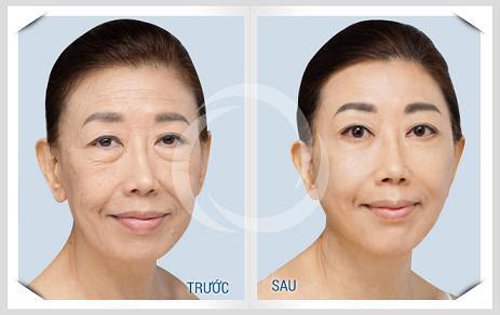 Solar Spa, Căng da, Trẻ hóa da, Căng da trẻ hóa