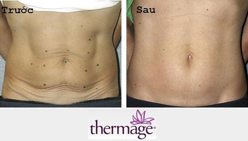 Solar Spa, Căng da, Trẻ hóa da, Căng da trẻ hóa