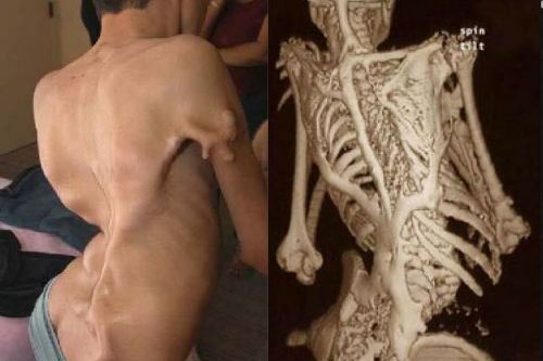 Bệnh lạ,bệnh người đá,hội chứng người đá,căn bệnh lạ đe dọa tính mạng con người