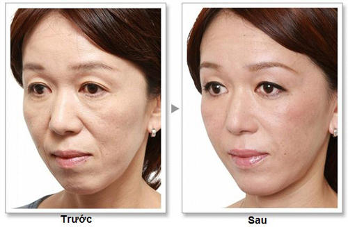 Solar Spa, Trẻ hóa da, Trẻ hóa da công nghệ cao, Thẩm mỹ viện Trẻ hóa da