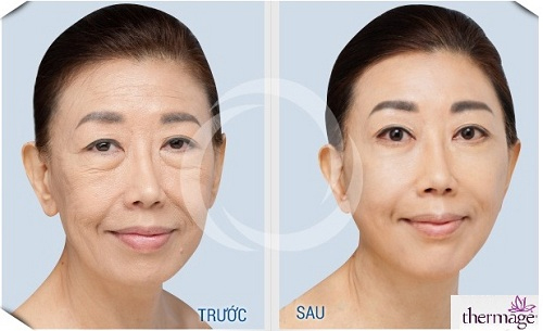 Solar Spa, Trẻ hóa da, Trẻ hóa da công nghệ cao, Thẩm mỹ viện Trẻ hóa da