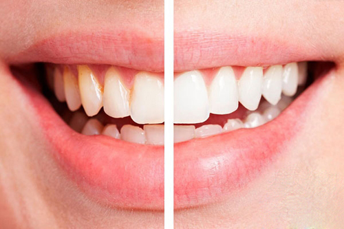 Chăm sóc răng, Làm trắng răng, Răng trắng tự nhiên