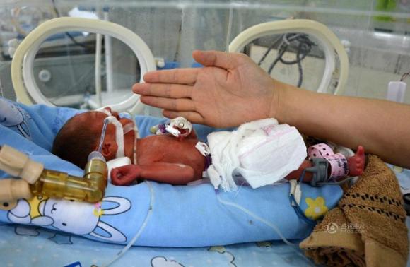 Bé sơ sinh,bé sơ sinh nặng 0.8 kg,'kỳ tích' bé sơ sinh nặng 0,8kg vẫn có thể sống sót