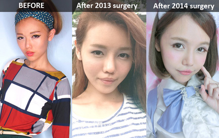 Hotgirl,hotgirl Singapore,hot girl Singapore công khai loạt ảnh sưng phù do phẫu thuật thẩm mỹ