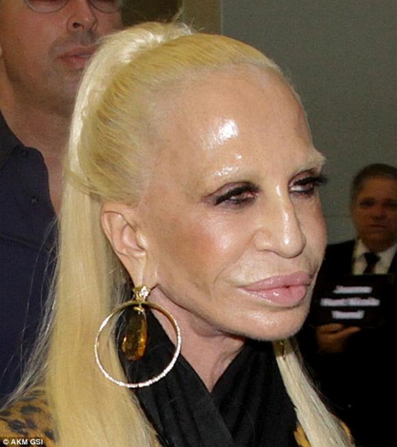 Donatella Versace dao kéo,Donatella Versace thảm họa thẩm mỹ,thảm họa thẩm mỹ của Hollywood,gương mặt Donatella Versace biến dạng
