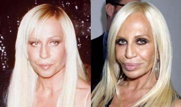 Donatella Versace dao kéo,Donatella Versace thảm họa thẩm mỹ,thảm họa thẩm mỹ của Hollywood,gương mặt Donatella Versace biến dạng
