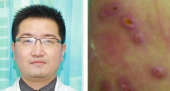 Con dòi,dòi làm tổ dưới da người,kinh hãi 20 con dòi bò lúc nhúc, làm tổ dưới da người 
