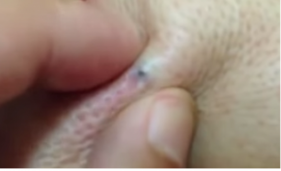 Con dòi,dòi làm tổ dưới da người,kinh hãi 20 con dòi bò lúc nhúc, làm tổ dưới da người 