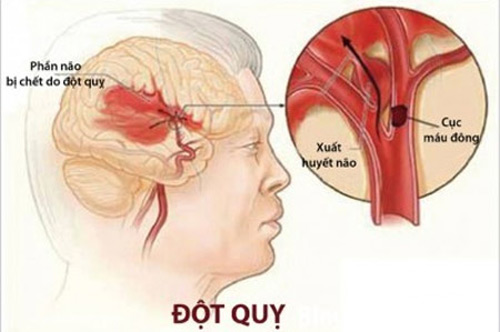 Đột quỵ,bệnh đột quỵ,bệnh nguy hiểm chết người dễ mắc vào mùa đông