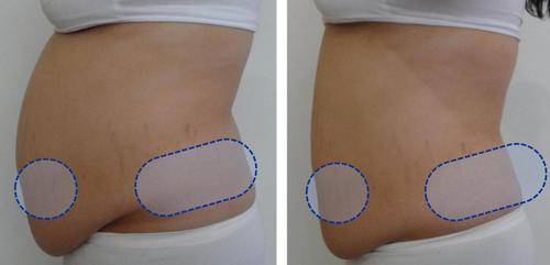 Hủy mỡ không phẫu thuật, Solar Spa, Thẩm mỹ công nghệ cao, Thẩm mỹ uy tín