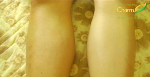 Triệt lông vĩnh viễn, Thẩm mỹ viện uy tín, Thẩm Mỹ công nghệ cao Charm