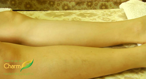 Triệt lông vĩnh viễn, Thẩm mỹ viện uy tín, Thẩm Mỹ công nghệ cao Charm