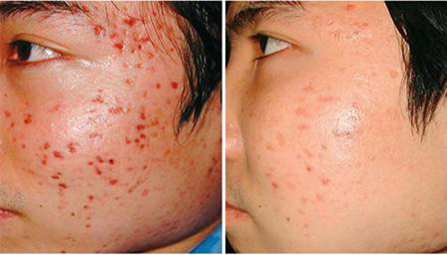 Solar Spa, Trị mụn, Điều trị mụn công nghệ cao, Thẩm mỹ viện trị mụn