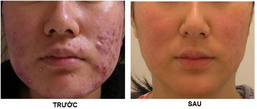 Solar Spa, Trị mụn, Điều trị mụn công nghệ cao, Thẩm mỹ viện trị mụn